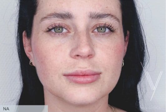 Lipfiller_ivy_clinics-detail