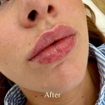 lip-filler-after-1-detail