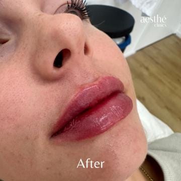 lip-filler-after-2-detail