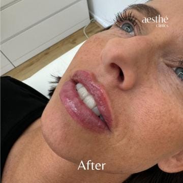 lip-filler-after-3-detail